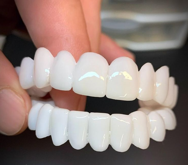 Dental Prosthesis — Customizable Veneers for a Natural Smile 2