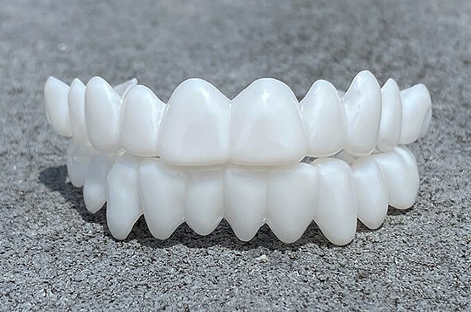 Dental Prosthesis — Customizable Veneers for a Natural Smile 3