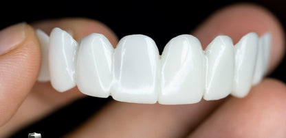 Dental Prosthesis — Customizable Veneers for a Natural Smile 4