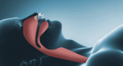 Micro CPAP Device — Portable Silent Anti-Snoring Sleep Aid 6